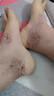 云南本草腳氣藥止癢脫皮爛腳丫真菌感染根100%草本足部抑菌腳臭專(zhuān)用的藥 買(mǎi)2發(fā)3【一噴見(jiàn)效】特噴霧劑效 草本水泡型治療真菌王凈克星膏 曬單實(shí)拍圖