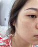 千龍源點(diǎn)痣藥水無(wú)疤痕臉部修復點(diǎn)疣瘊子醫用祛雀斑美容院專(zhuān)用金水遺傳膏 一盒體驗裝 曬單實(shí)拍圖