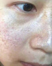 醫用精華液械字號收縮毛孔粗大修復細致去黑頭粉刺閉口男士女士祛痘印黑色素沉淀控油淡化痘印痘坑透明質(zhì)酸鈉 曬單實(shí)拍圖