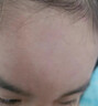 藤石制藥水痘疤痕修復凝膠兒童臉部凹陷成人祛水痘痘印痘坑可搭專(zhuān)用膏淡化疤痕疙瘩藥黑色素沉淀去除非藥ZE 3盒裝【多處水痘痘印疤痕】買(mǎi)二送一 曬單實(shí)拍圖