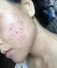 YYTISS祛痘藥膏淡化痘印消除坑炎痤瘡專用青少年去痘痘和痘印青春痘學(xué)生 曬單實(shí)拍圖
