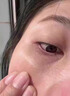 脂肪粒祛除神器眼部顆粒眼角眼周油脂粒扁平粒眼霜男女士 去脂肪粒神器 曬單實(shí)拍圖