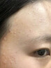 阿達帕林凝膠改善毛孔粗大去黑頭醫用收縮毛孔粗大修復細致醫用男女士去黑頭收縮毛孔粉刺深層清潔清理神器 1盒【毛孔粗大粉刺黑頭多專(zhuān)用藥】 曬單實(shí)拍圖