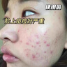 泊紫汀蘭祛痘膏祛痘淡化痘印消閉口修護痘痕痘坑去粉刺控油青春痘男女學(xué)生 曬單實(shí)拍圖