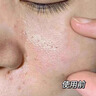 醫用精華液械字號收縮毛孔粗大修復細致去黑頭粉刺閉口男士女士祛痘印黑色素沉淀控油淡化痘印痘坑透明質(zhì)酸鈉 曬單實(shí)拍圖