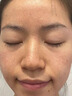醫用精華液械字號收縮毛孔粗大修復細致去黑頭粉刺閉口男士女士祛痘印黑色素沉淀控油淡化痘印痘坑透明質(zhì)酸鈉 曬單實(shí)拍圖