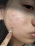 代文痘坑凹洞痘印痘疤凹坑凹陷疤痕男生長(cháng)因子微針可搭祛痘修復凝膠CN 買(mǎi)3送2【5盒】嚴重大面積痘印痘坑凹洞填充再生 曬單實(shí)拍圖