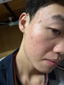 老中醫（LAOZHONGYI）祛痘膏痘清霜男女士 淡化痘印痘坑痘疤青少年去青春痘黑頭粉刺 痘清霜20g 曬單實(shí)拍圖