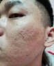 痘印痘坑修復凹洞祛痘去痘印去閉口粉刺去黑頭痘坑男士祛痘疤膏藥 (發(fā)貨特效)買(mǎi)2送1【痘坑痘印凹洞】可試用 去痘痘和痘印淡化消除填充再生凝膠生長(cháng)因子女男生醫用 曬單實(shí)拍圖