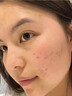 白云山壬二酸祛痘面膜10片淡化痘印控油祛痘毛孔收縮補水保濕男女士 曬單實(shí)拍圖