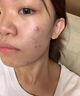 維特絲愈創(chuàng  )木祛痘精華淡化痘印去痘痘收毛孔男女士護膚品青春期學(xué)生專(zhuān)用 曬單實(shí)拍圖