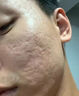 DR.AVIN德國公司監制痘坑修復凹洞男祛痘坑痘印痘疤醫用填充劑生長(cháng)因子HW 【兩盒優(yōu)惠裝】第二盒半價(jià)【店長(cháng)推薦】 曬單實(shí)拍圖