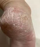 角化型腳氣頑固性真菌感染角質(zhì)增厚腳后跟干裂專(zhuān)用藥腳脫皮去真菌皮膚干裂脫皮厚硬手足鱗屑型硝酸咪康唑乳膏 1盒【足跟粗糙開(kāi)裂脫皮】主圖視覺(jué)特效 曬單實(shí)拍圖