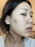 維特絲愈創(chuàng  )木祛痘精華淡化痘印去痘痘收毛孔男女士護膚品青春期學(xué)生專(zhuān)用 曬單實(shí)拍圖