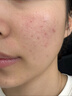 維特絲愈創(chuàng  )木祛痘精華淡化痘印去痘痘收毛孔男女士護膚品青春期學(xué)生專(zhuān)用 曬單實(shí)拍圖