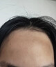 醫續美額頭黑色素沉淀去除臉上黑斑點(diǎn)醫用面部痘印淡化消除祛黑印臉部LD 兩盒裝【第二盒半價(jià)】 曬單實(shí)拍圖