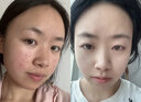 泊紫汀蘭壬二酸祛痘膏淡化痘印痘坑去閉口粉刺男女士學(xué)生青春痘水楊酸面霜 曬單實(shí)拍圖