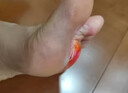 ELSIEDOCTOR制藥雞眼膏去肉刺根膏去無(wú)痛脫落連拔跖疣專(zhuān)用腳根底瘊子雞眼貼 曬單實(shí)拍圖