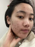 泊紫汀蘭壬二酸祛痘膏淡化痘印痘坑去閉口粉刺男女士學(xué)生青春痘水楊酸面霜 曬單實(shí)拍圖