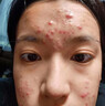 YYTISS祛痘膏修復淡化消除痘印痘坑青春期學(xué)生少年消炎痤瘡去痘專(zhuān)用凝膠 曬單實(shí)拍圖