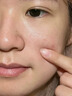 醫用精華液械字號收縮毛孔粗大修復細致去黑頭粉刺閉口男士女士祛痘印黑色素沉淀控油淡化痘印痘坑透明質(zhì)酸鈉 曬單實(shí)拍圖