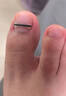 Dr.JYS鈦合金甲溝炎矯正器神指甲長(cháng)肉里嵌甲糾正專(zhuān)用正甲貼片 曬單實(shí)拍圖