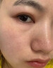 醫用精華液械字號收縮毛孔粗大修復細致去黑頭粉刺閉口男士女士祛痘印黑色素沉淀控油淡化痘印痘坑透明質(zhì)酸鈉 曬單實(shí)拍圖