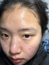 韓方五谷壬二酸祛痘藥膏祛痘淡化痘印煙酰胺凝膠水楊酸膠態(tài)硫青春期學(xué)生 曬單實(shí)拍圖