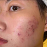 OHBT壬二酸祛痘藥膏水楊酸凝膠祛痘痘和淡化痘印坑消炎痤瘡專(zhuān)用青少年 曬單實(shí)拍圖