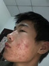 井次制藥祛痘膏去痘痘青春痘淡化痘印修復痘疤初高中男女學(xué)生閉口粉刺痤瘡 曬單實(shí)拍圖