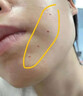MEROYDOCTOR去痣點(diǎn)痣膏正品點(diǎn)痣無(wú)痛無(wú)痕祛痣黑痣臉部去痣祛斑專(zhuān)用不留疤痕 曬單實(shí)拍圖