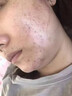 修正祛痘印修復淡化痘印醫用男士女黑色素沉淀藥膏青少年消除痘坑專(zhuān)用 【買(mǎi)二送一】發(fā)3盒 祛痘疤痕專(zhuān)用修復凝膠膠原蛋白 曬單實(shí)拍圖