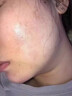 修正祛痘印修復淡化痘印醫用男士女黑色素沉淀藥膏青少年消除痘坑專(zhuān)用 【買(mǎi)二送一】發(fā)3盒 祛痘疤痕專(zhuān)用修復凝膠膠原蛋白 曬單實(shí)拍圖