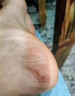 腳后跟干裂起硬皮足跟開(kāi)裂腳裂膏腳后跟干裂開(kāi)裂真菌感染腳干燥足后跟開(kāi)裂脫皮防裂膏手足干裂硝酸咪康唑乳膏 1盒【腳干裂脫皮真菌感染】 曬單實(shí)拍圖