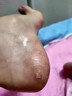 腳后跟干裂起硬皮足跟開(kāi)裂腳裂膏腳后跟干裂開(kāi)裂真菌感染腳干燥足后跟開(kāi)裂脫皮防裂膏手足干裂硝酸咪康唑乳膏 1盒【腳干裂脫皮真菌感染】 曬單實(shí)拍圖