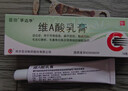 維A酸乳膏去疣體特新效期藥扁平疣專(zhuān)用藥去疣類(lèi)藥膏去脖子小肉粒頸部瘊子去尤瘊小肉粒去疣膏瘊子肉刺肉粒 1盒裝【國藥準字脫疣瘊】 瘊子去除國藥準字藥膏  放心購買(mǎi) 安心售后 曬單實(shí)拍圖