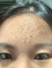 ORGINESE水楊酸祛痘面霜控油舒緩保濕青春痘淡化痘印痘坑去粉刺閉口男女士 曬單實(shí)拍圖