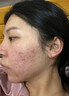 BEAUTY NOTES壬二酸凝膠20%祛痘藥膏淡化痘印痘坑修復男士水楊酸消炎痤瘡專(zhuān)用 曬單實(shí)拍圖