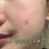 膚草集痘痘貼消炎吸膿修復痘印隱形遮瑕隔污抗痘祛痘可化妝水膠體108片 曬單實(shí)拍圖