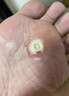 ELSIEDOCTOR制藥雞眼膏去肉刺根膏去無(wú)痛脫落連拔跖疣專(zhuān)用腳根底瘊子雞眼貼 曬單實(shí)拍圖