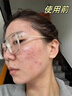 黎村梁氏草本植萃祛痘修護精華液植物膏粉刺天然淡化閉口青春油肌印霜 梁氏草本植萃祛痘修護精華液【15ml】兩瓶 曬單實拍圖