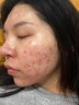 BEAUTY NOTES壬二酸凝膠20%祛痘藥膏淡化痘印痘坑修復男士水楊酸消炎痤瘡專(zhuān)用 曬單實(shí)拍圖
