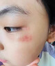 BKWILD醫用重組生長(cháng)因子凝膠膠原蛋白點(diǎn)痣噴人表皮祛疤痕膏修復生肌膏 曬單實(shí)拍圖