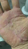 手部角化型濕疹可搭藥膏手足癬真菌感染手指手掌皮膚瘙癢干燥粗糙硬塊皸裂角化皸裂性濕疹抑菌止癢膏 單盒裝 曬單實(shí)拍圖