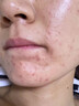 同仁堂祛痘膏去痘痘和痘印痘坑修復男女士改善粉刺閉口30g 曬單實(shí)拍圖