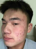 儒意（RUYI）壬二酸祛痘藥膏凝膠態(tài)硫修復淡化痘印水楊酸學(xué)生青春痘痤瘡青少年 曬單實(shí)拍圖