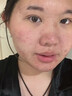 維特絲水楊酸祛痘精華淡化痘印去痘痘收毛孔男女士護膚品青春期學(xué)生專(zhuān)用 曬單實(shí)拍圖