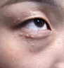 鄒潤安汗管瘤專(zhuān)用的藥脂肪粒眼部專(zhuān)用去除神器祛眼周扁平疣栗丘疹點(diǎn)藥膏 買(mǎi)2送1【快速消除】 曬單實(shí)拍圖