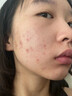 同仁堂祛痘膏去痘痘和痘印痘坑修復男女士改善粉刺閉口30g 曬單實(shí)拍圖