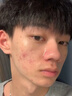 佰氏本草祛痘膏淡化痘印修復去痘印坑消炎痤瘡專(zhuān)用少年學(xué)生青春痘藥膏1瓶 曬單實(shí)拍圖
